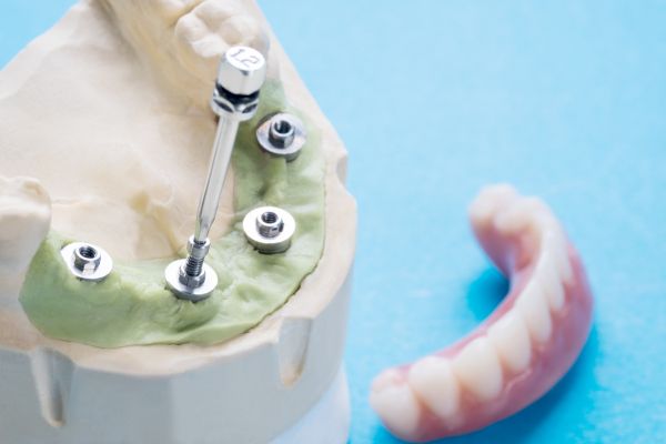 Dental Implant example in a plaster cast.