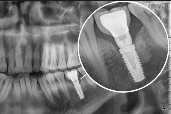 Photo of a dental implant x-ray.