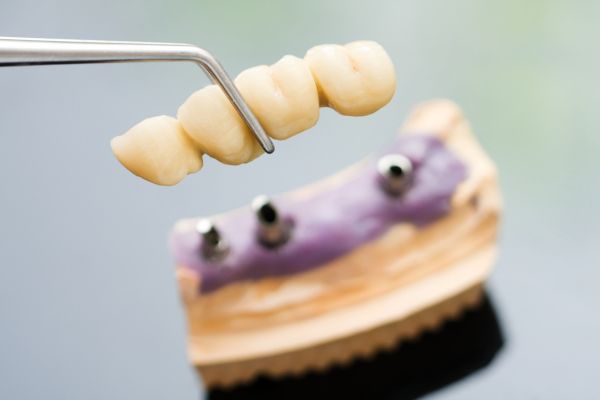 Dental Implants in Newport example with arch