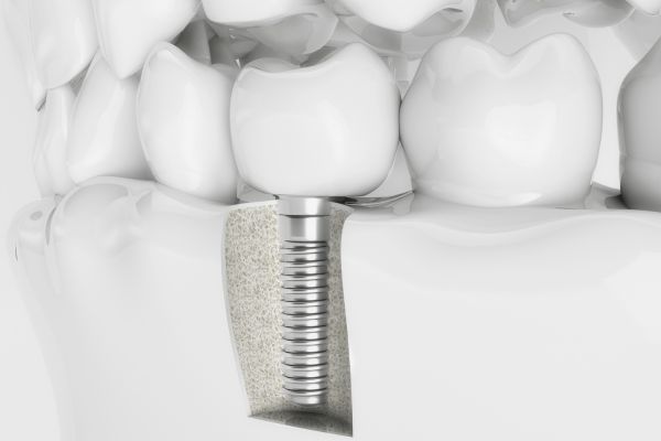 Dental Implants - side view diagram of a dental implant