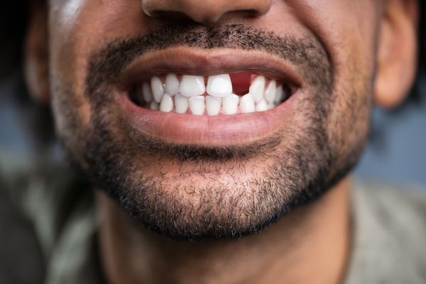 Close-up photo of a man's open mouth showing his teeth. He has one upper tooth missing.